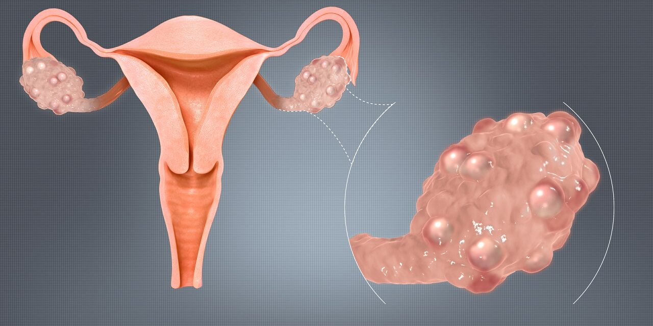 polycystic ovaries 1280x640